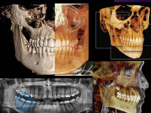 cbct